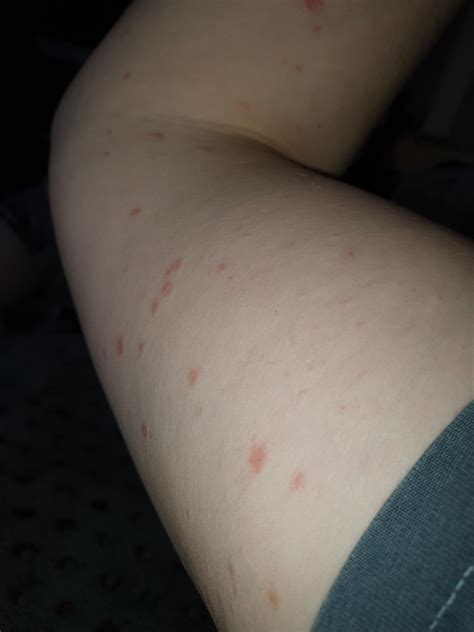 Raised Red Rash All Over Arms And Groin Not Itchy Or Painful Has
