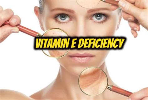 Vitamin E Deficiency विटामिन ई की कमी