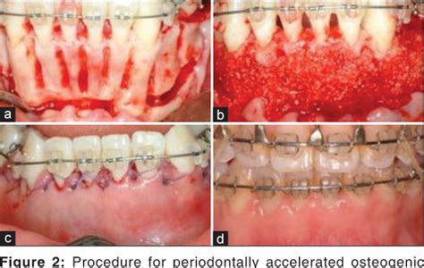 Figure 2 From Periodontally Accelerated Osteogenic Orthodontics An