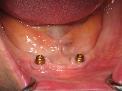 Snap In Dentures On Dental Implants Burbank Dental Implant Specialist
