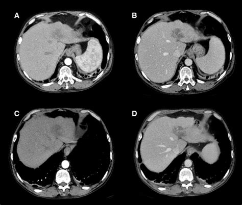 Follow Up Ct Scans Before And After Intravenous Injection Of Iodine