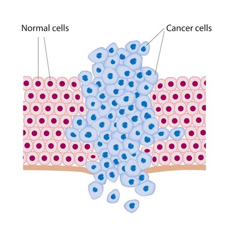 Cancer Is Not A Disease But A Biological Event Prachodayat