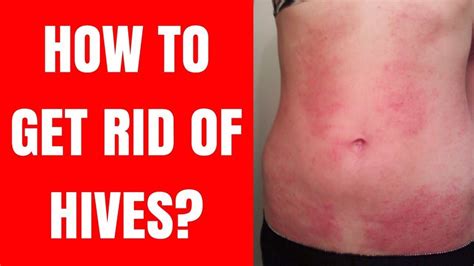 Pin On Hives