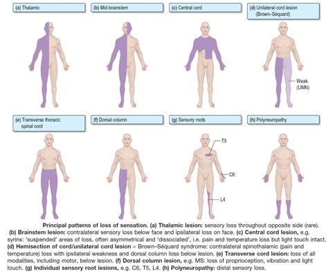 Principal Patterns Of Loss Of Sensation A Thalamic Grepmed