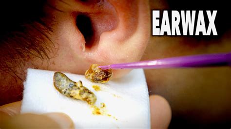 The Best Earwax Removal Ever And Most Gross Dr Paul Viyoutube