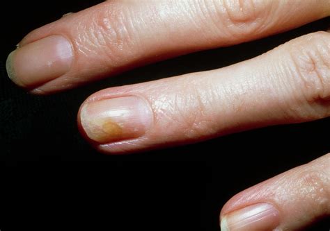 Tinea Fungal Infection Of A Woman S Fingernail Photograph By Mike Devlin Science Photo Library