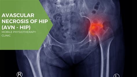 Avascular Necrosis Of Hip Avn Hip Cause Symptoms Treatment Mobile