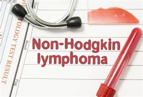 Early Warning Signs Of Non Hodgkins Lymphoma Vitalhealth