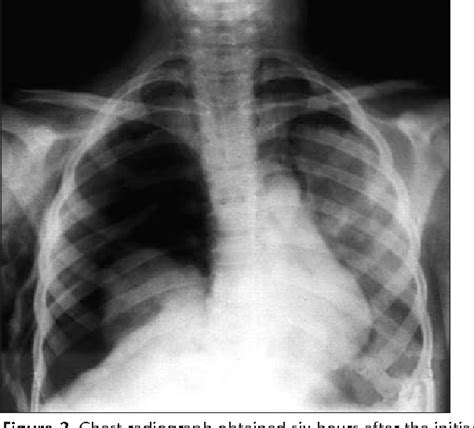Pdf Fallen Lung Sign Radiographic Findings Semantic Scholar