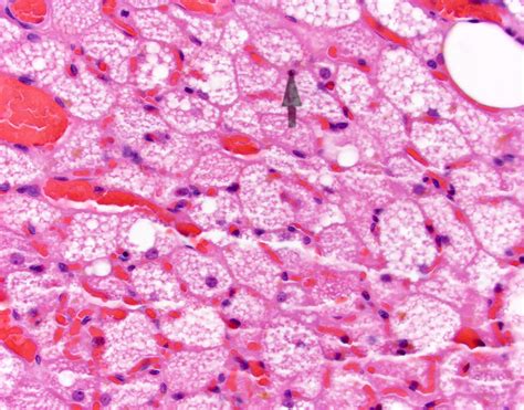 Pathology Outlines Histology Brown And White Adipose