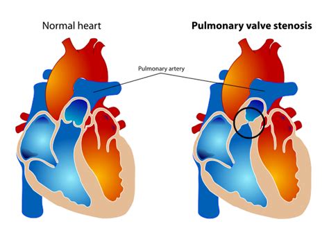 Pulmonary Valve Stenosis Wikidoc
