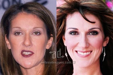 Soulmate Com The New Smile Of Celine Dion Afterdental Surgery Celebrity Teeth Celine Dion