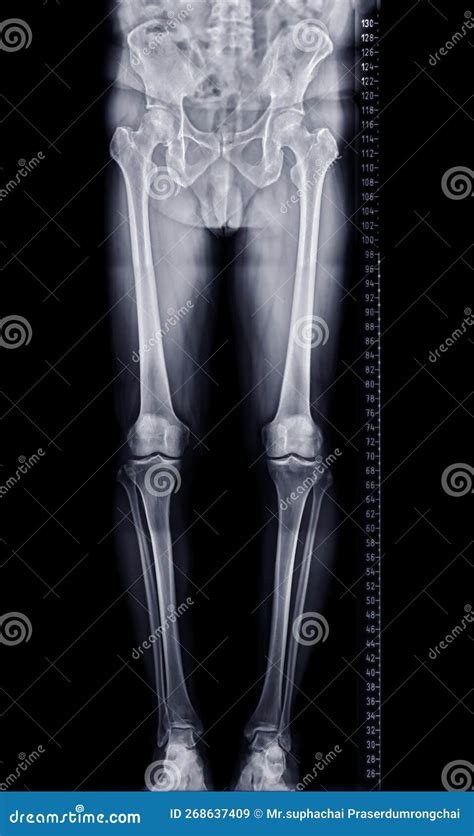 Scanogram Is A Full Length Standing Ap Radiograph Of Both Lower