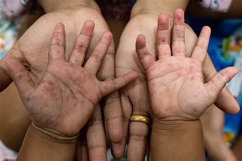 hand foot and mouth disease nhs