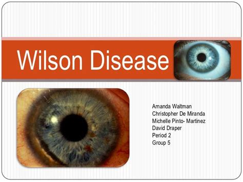 Early Symptoms Of Wilsons Disease Recognize Disease
