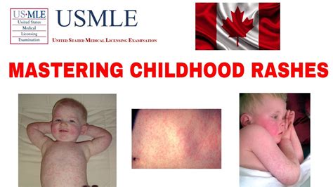Mastering Childhood Rashes Measles Rubella Roseola Scarlet Fever Usmle