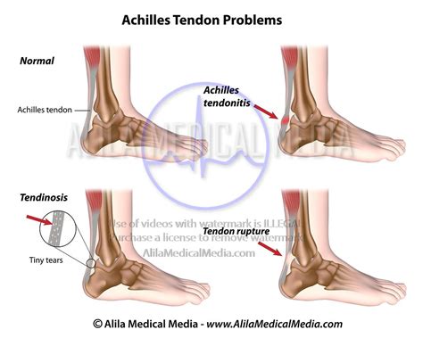 Alila Medical Media Achilles Tendon Problems Medical Illustration