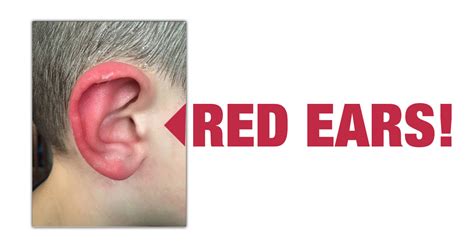 Red Ears