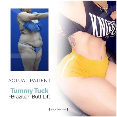 Best sleeping positions after a tummy tuck and bbl. Promociones | evoclinic