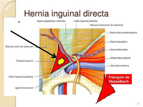 Diagnóstico De Hernia Inguinal Por Tc