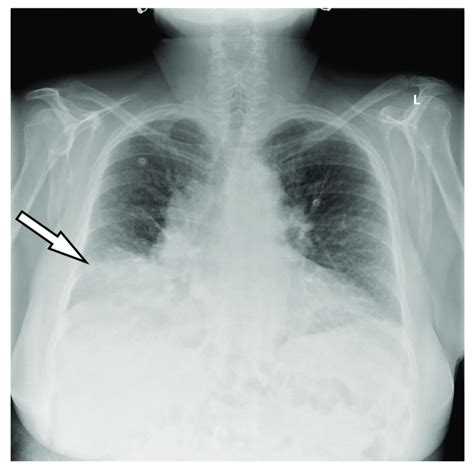 Posteroanterior Chest X Ray A Right Lower Pulmonary Lobe Consolidation