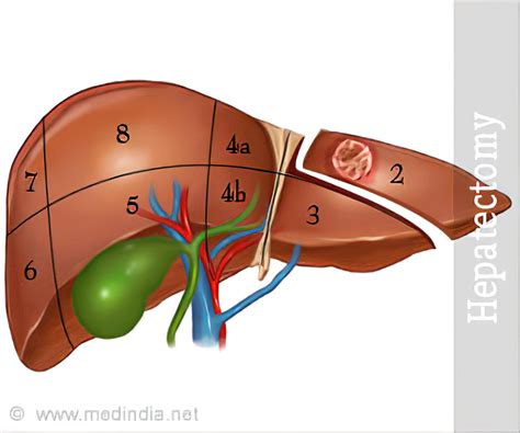 Hepatectomy Indications Tests Complications