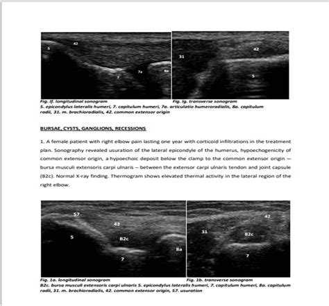 Sonographic And Thermographic Findings Of The Elbow Clinical Practise