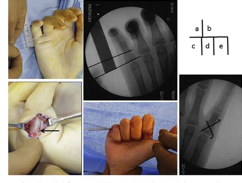Figure 4 From Corrective Osteotomy For Malunited Small Finger Proximal