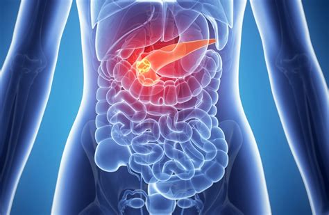 Metastatic Pancreatic Cancer A New Clinical Practice Guideline The