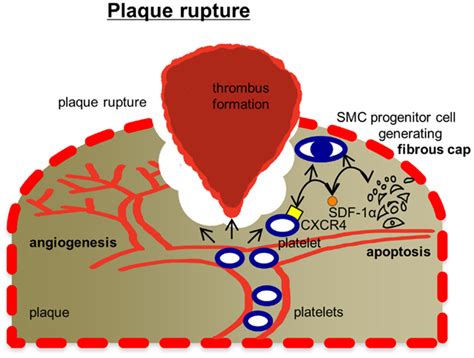 Mechanisms How Platelets Affect Plaque Rupture Plaque Rupture Is