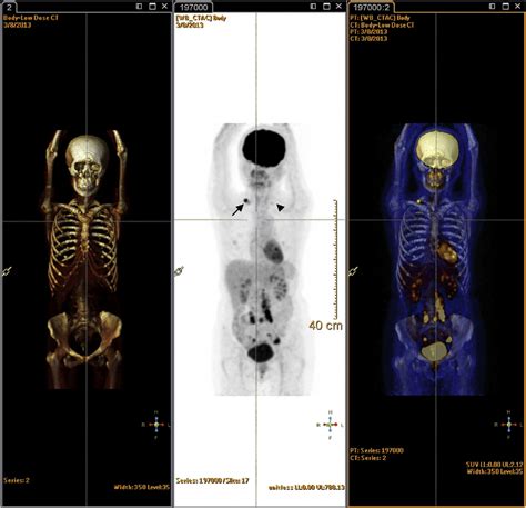Whole Body Petct Scan Anterior Projection Image Of Petct Scan With