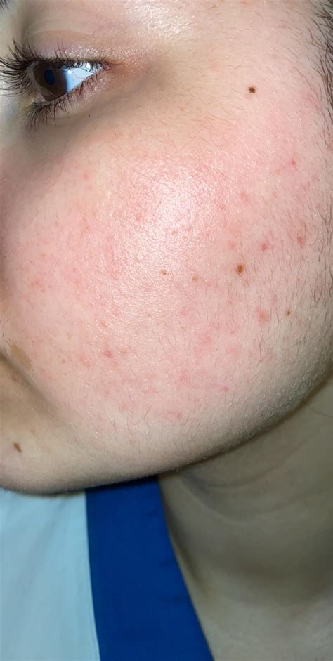 Question Red Dots On My Face Skincareaddicts