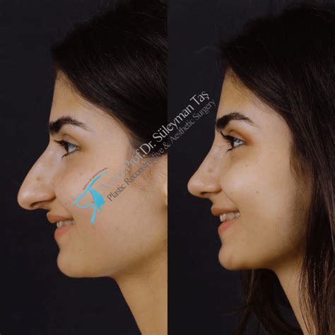 How Much Is The Price Of Rhinoplasty Assoc Prof Dr Suleyman Tas