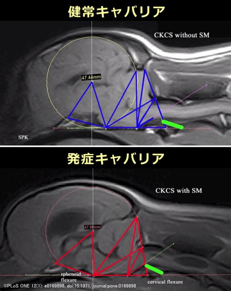 脊髄空洞症とは、 脊髄内に空洞（水たまり）を形成する慢性進行性の疾患 で、1)キアリ奇形（小脳の一部が脊柱管内に落ち込んでしまっている状態） 2)脊髄腫瘍 3)脳底部および脊髄くも膜炎 4)脊髄外傷 5)脊髄髄膜瘤 6)その他などの原因が知られています。 犬の小型化や短頭化が脊髄空洞症の発症リスクを高めている