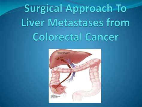 Ppt Surgical Approach To Liver Metastases From Colorectal Cancer