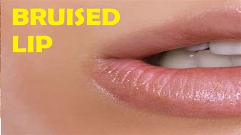 How To Get Rid Of Bruised Lips From Suction