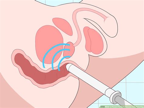 Perianal Abscess Causes Telegraph