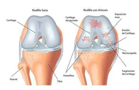 Qué es la artrosis y cómo tratar el dolor en las articulaciones