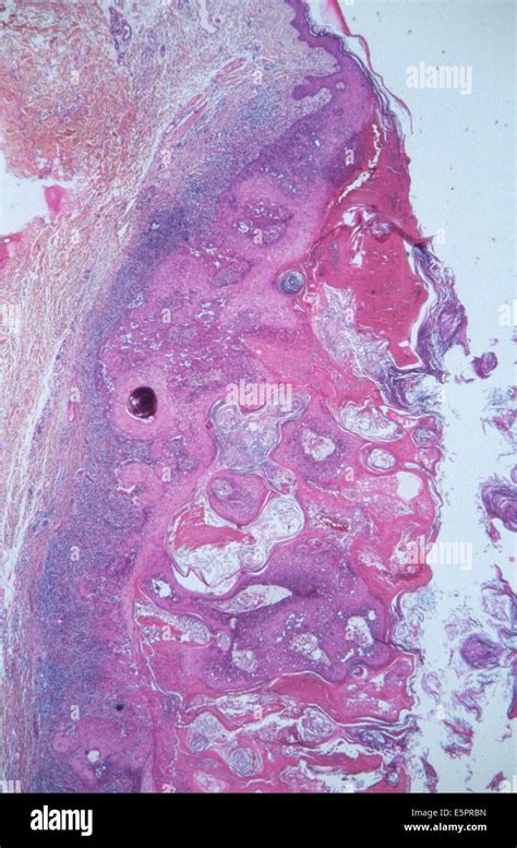 Keratoacanthoma Skin Precancerous Lesion Light Microscopy Stock Photo