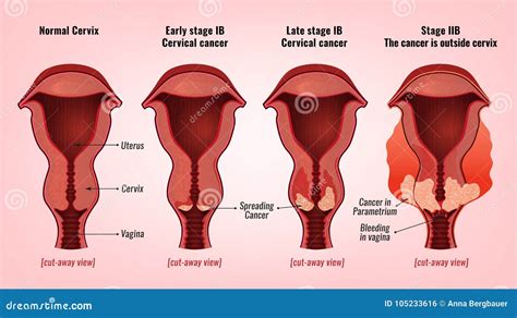 Cervical Cancer Carcinoma Of Cervix Vector Illustration