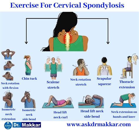 Cervical Spondylosis Neck Pain Neck Pain Leads To Giddiness