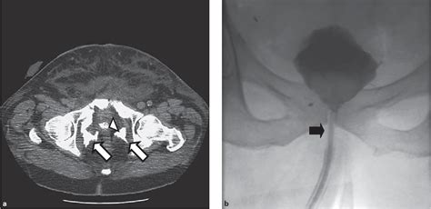 Figure 2 From Management Of Prolonged Urinary Leakage At The Urethro Vesical Anastomosis