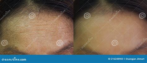 Problem Skincare And Health Concept Wrinkles Melasma Dark Spots