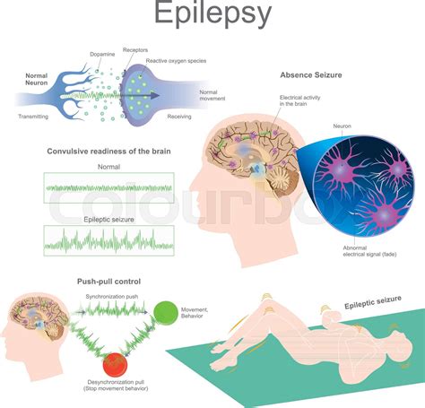 Epilepsy โรคลมชัก Stock Vector Colourbox