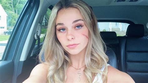 Tiktoks Scar Girl Opens Up About Viral Fame