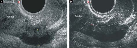 Sagittal Transvaginal Ultrasound Images Of The Posterior Compartment Of