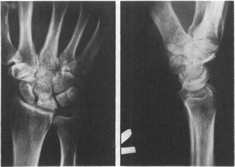 Posteroanterior A And Lateral B Radiographs Of The Wrist Show