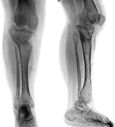 Ap And Lat Radiographs Of The Right Tibia After Frame Removal Note
