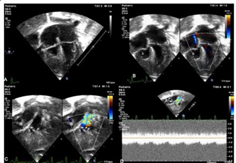 Echocardiogram Showing Hypoplastic And Hypertrophied Right Ventricle