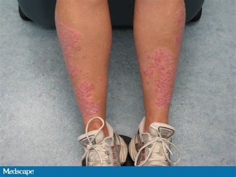 The Treatment Of Moderate To Severe Plaque Psoriasis A Case Based
